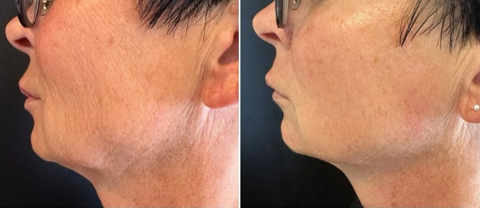 Before and after 3 Miami facial treatments using the T-Shape 2 at Casa Privee. Get the best facial skin tightening Miami offers today.