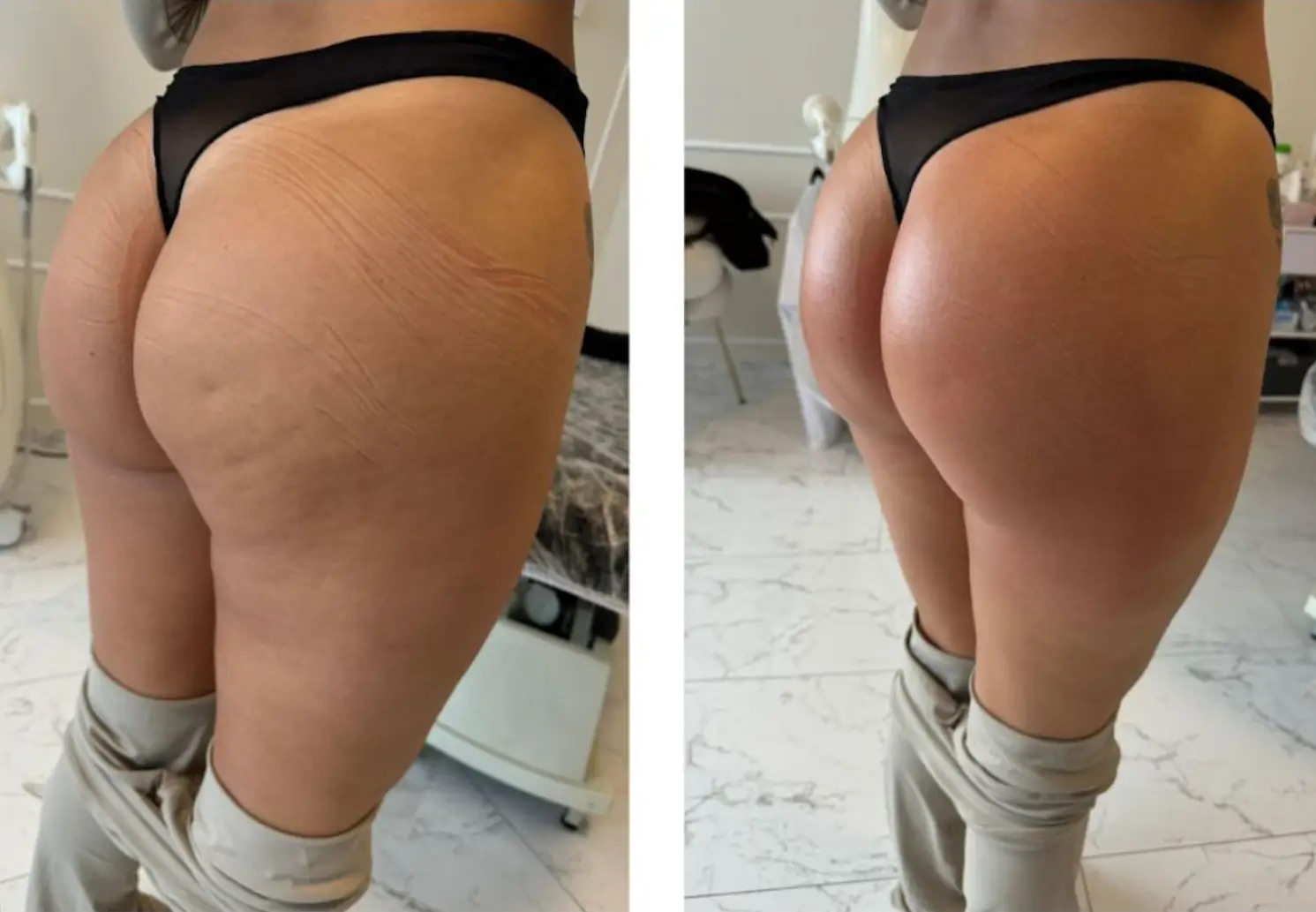 Before and after results after 1 session with the Artemis T-Shape 2 body sculpting in Miami, FL.