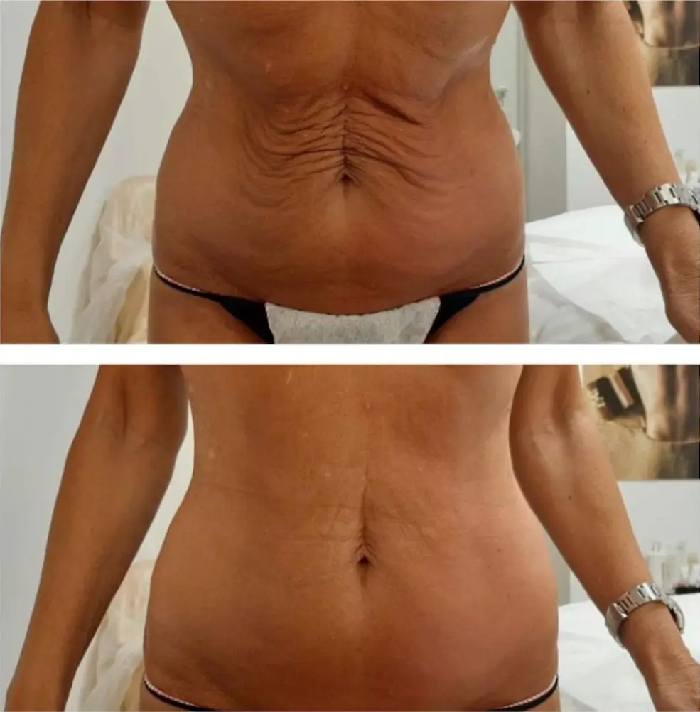 Miami body contouring with T-Shape 2 to reduce fat (weight loss) and tighten loose skin.