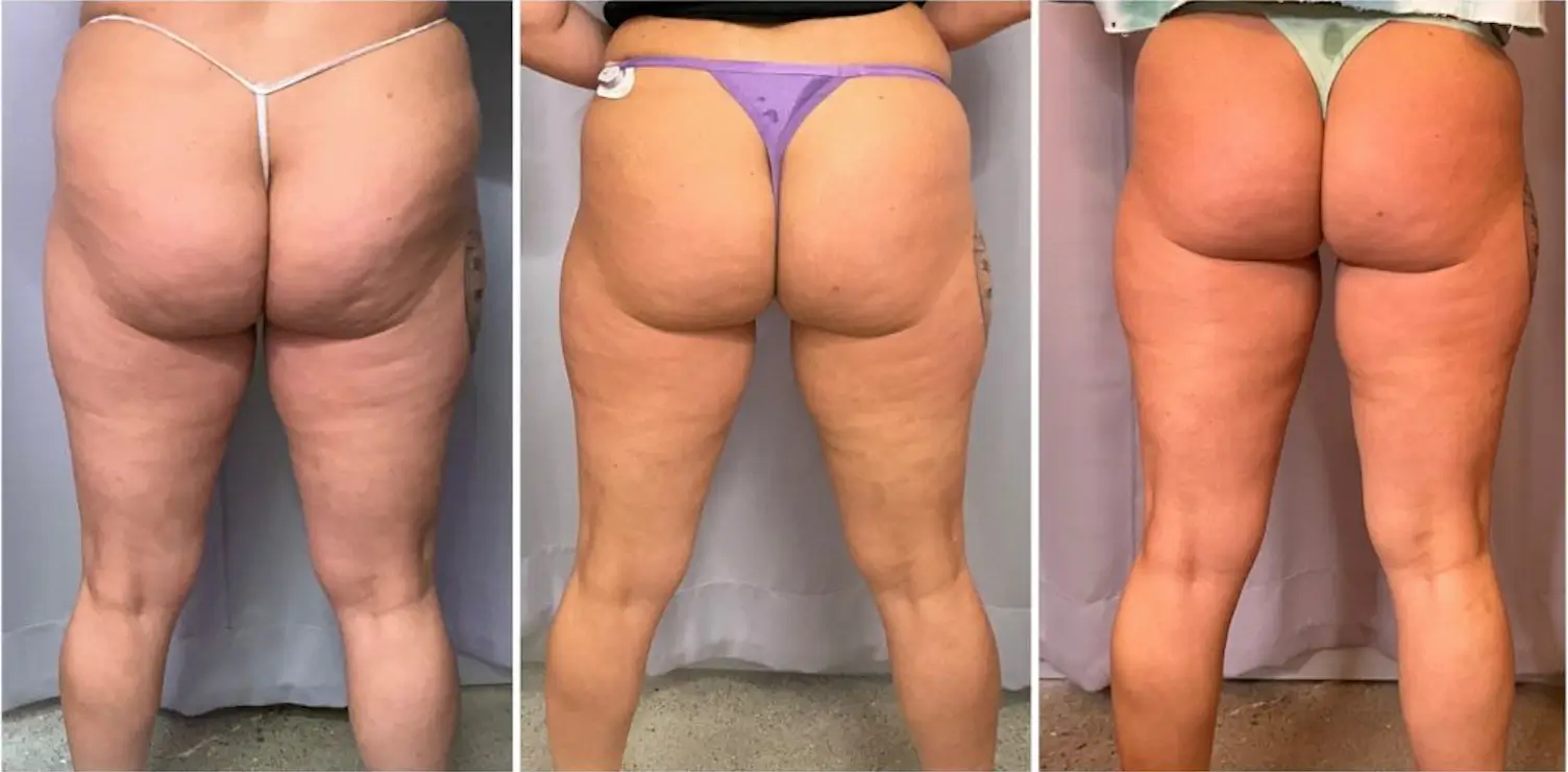 Results after 3 sessions for cellulite treatment in Miami, Florida at Casa Privee with the Artemis T-shape 2.
