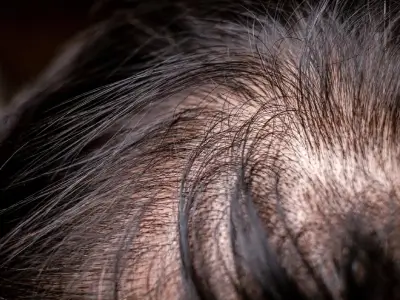 Treatments for mild hair loss include vitamin and nutrition recommendations, low-level laser therapy, and hair replenishment products.