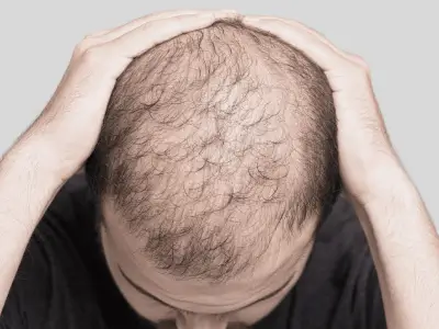 Severe hair thinning and loss solutions include PRP injections, Finastride, and hair restoration products.