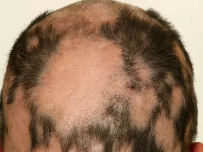 Our extreme hair loss restoration in Miami uses Regenenerative Protein Array (RPA) combined with exosome and stem cell treatments to regrow your hair.